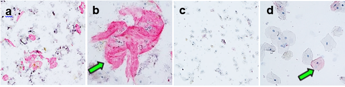 IHC assay of dementia biomarker in clinical saliva samples - four panels: a-b show high biomarker expression in saliva from Neurocognitive Disorder due to mild TBI (NCDT), c-d show baseline expression in healthy control