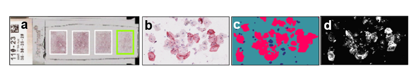 Digital IHC assay of saliva with cells - four panels: a) digitized IHC slide with saliva microarray, b) Mucin1 in epithelial cells, c) segmented image, d) staining intensity map