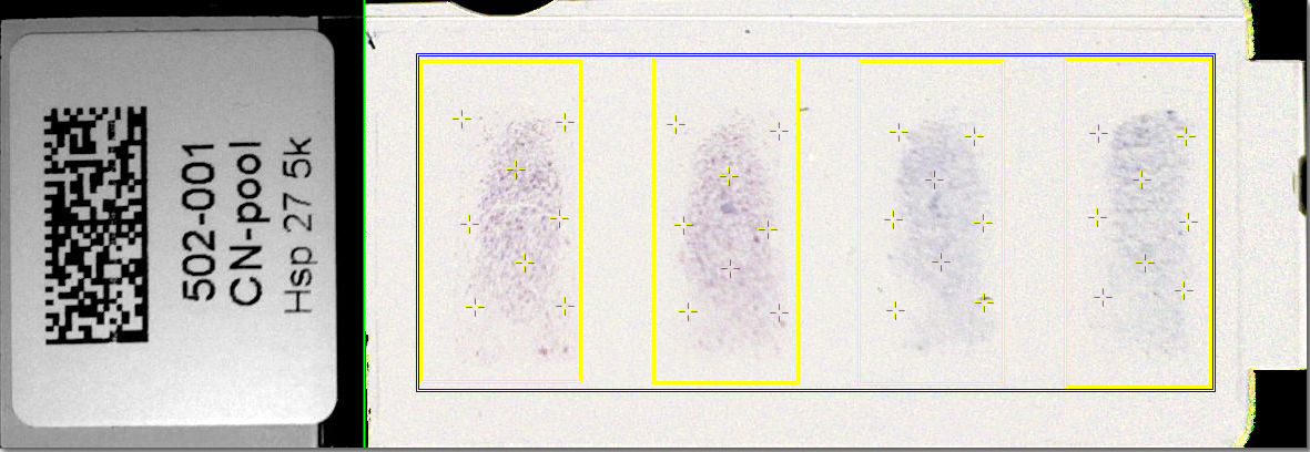 Saliva microarray slide with Region of Interest profiles for the Hsp27 biomarker
