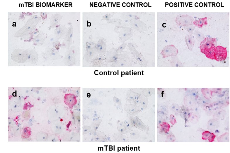 IHC assay of mTBI biomarker in clinical saliva samples - six panels a-f comparing a control patient (a-c) and an mTBI patient (d-f) across mTBI biomarker, negative control, and positive control