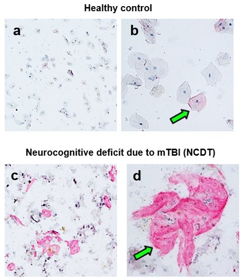 IHC assay of NCDT biomarker in clinical saliva samples - four panels: a-b healthy control with baseline biomarker expression, c-d Neurocognitive Disorder due to mTBI (NCDT) with high biomarker expression in saliva epithelial cells