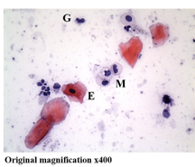 Cellular composition of human saliva — Hematoxylin and Eosin stain, original magnification x400, showing epithelial cells (E), granulocytes (G), monocytes (M), and lymphocytes