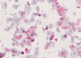 Digital image of a saliva IHC stain showing epithelial cells