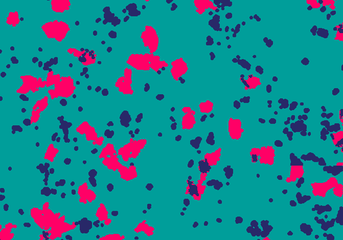 Conventional RGB algorithm segmentation result showing scattered magenta epithelial cells and dark blue non-epithelial cells in a clinical saliva specimen from dementia